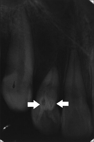 22-old-year male with pain and tenderness in the right maxillary lateral incisor diagnosed with dens invaginatus Type 2 in tooth 22 and double dens invaginatus in tooth 12. Intra-oral radiograph of tooth 12 shows the double dens invaginatus and the presence of two enamel lined invaginations (arrows).